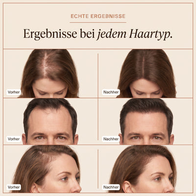 ZeNevo™ Grow:Turn Ampoule Korea's №1 Hair Growth Secret – Jetzt in Deutschland